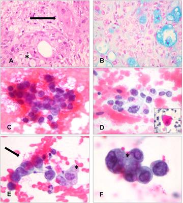 Cytology of Primary Salivary Gland-Type Tumors of the Lower Respiratory Tract: Report of 15 Cases and Review of the Literature